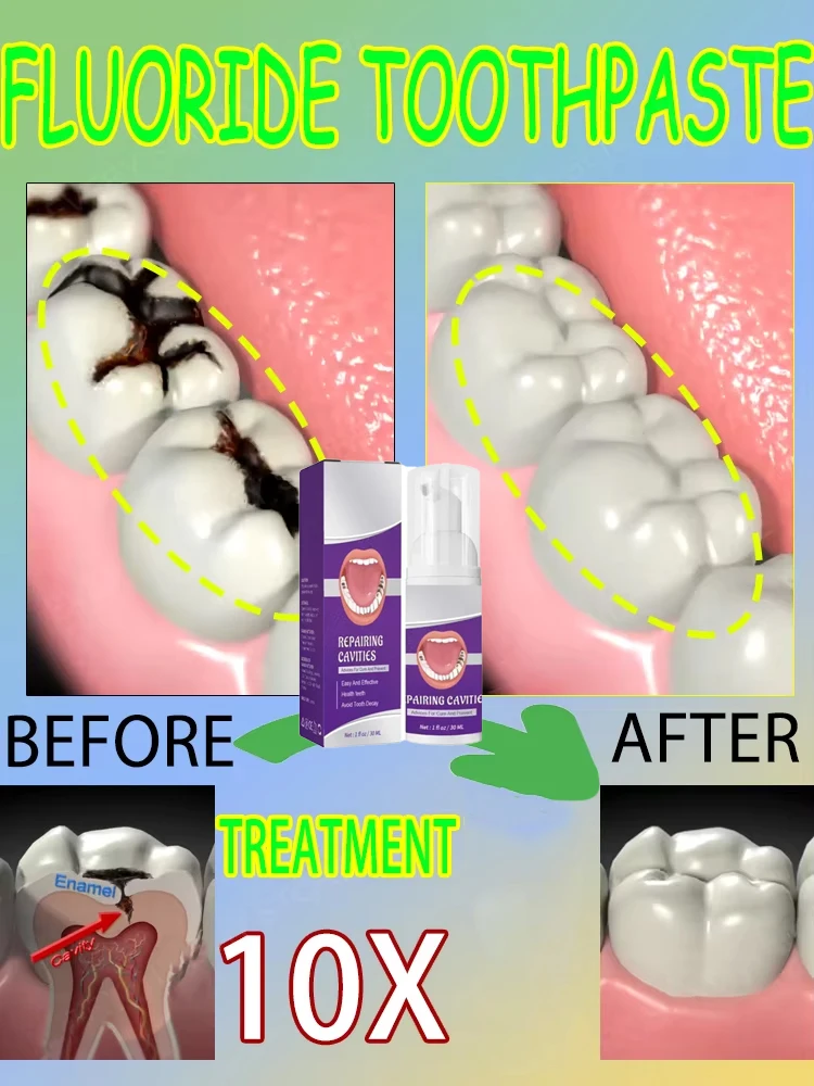 Teeth Whitening That Works - Hot sales Best-selling, Scientific Repairs Cavities,