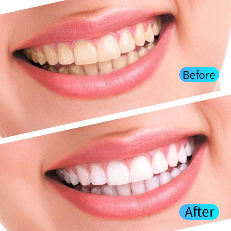 Teeth Whitening Gel Kit Oral H - Teeth Whitening Filter ulasan dan harga