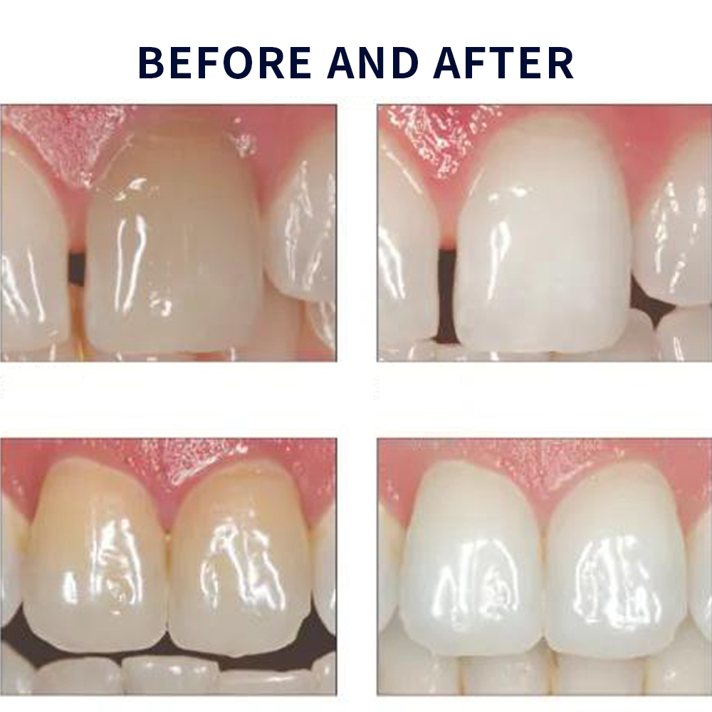 Opalescence Whitening 20% PF 2 - Teeth Whitening Q&M ulasan dan harga