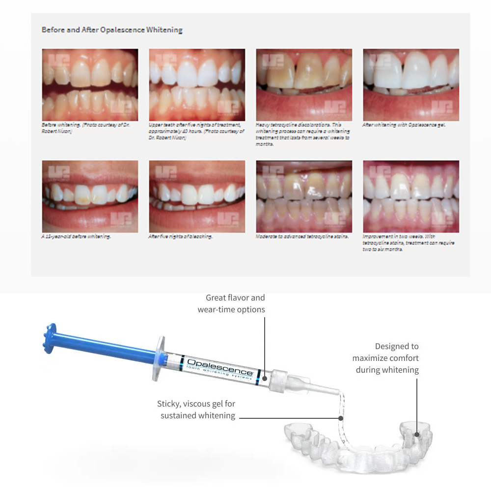 Opalescence Whitening 20% PF 2 - Teeth Whitening Q&M ulasan dan harga