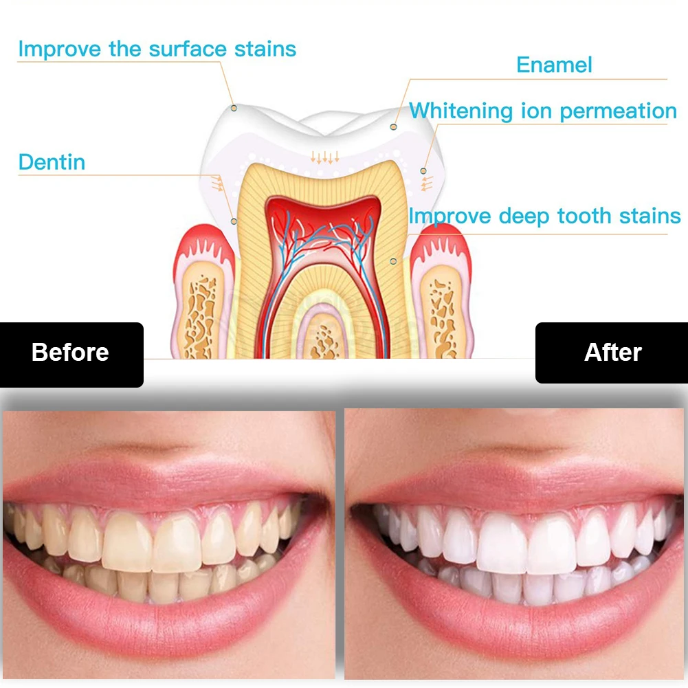 Dental Teeth Whitening Kit Min - Teeth Whitening Device ulasan dan harga